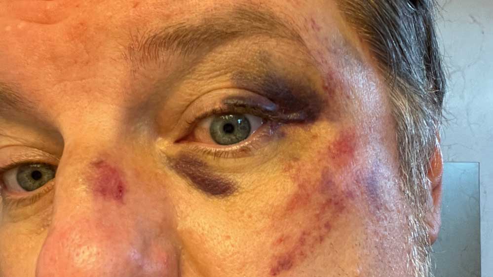 Alex Shtaerman Injuries